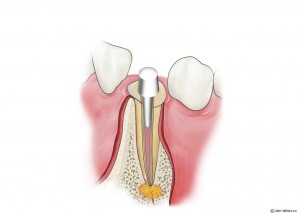 感染根管治療4　土台の装着